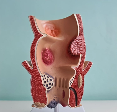 Rectal Bleeding